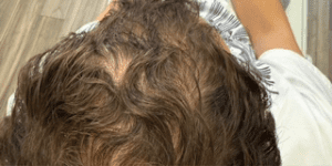 Hair restoration results showing fuller, thicker, and healthier-looking hair after treatment