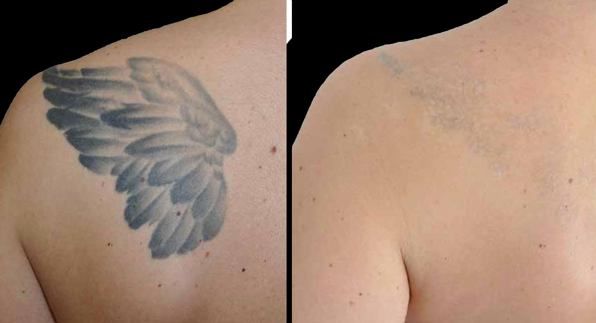 Tattoo removal treatment in Murfreesboro TN using laser technology